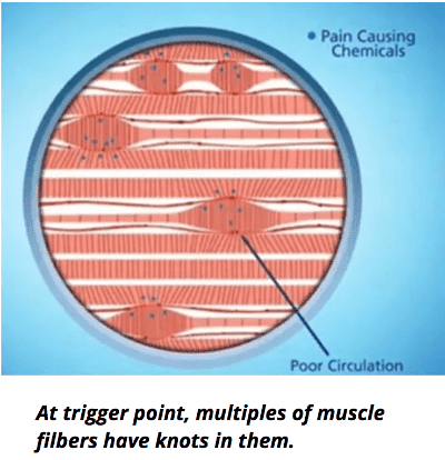 trigger point of muscle fibers