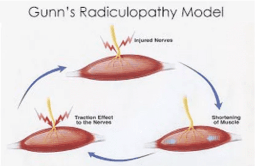 radiculopathy model
